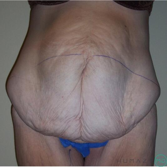 Tummy tuck Before & After Image