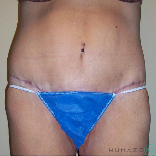 Tummy tuck Before & After Image