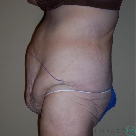 Tummy tuck Before & After Image