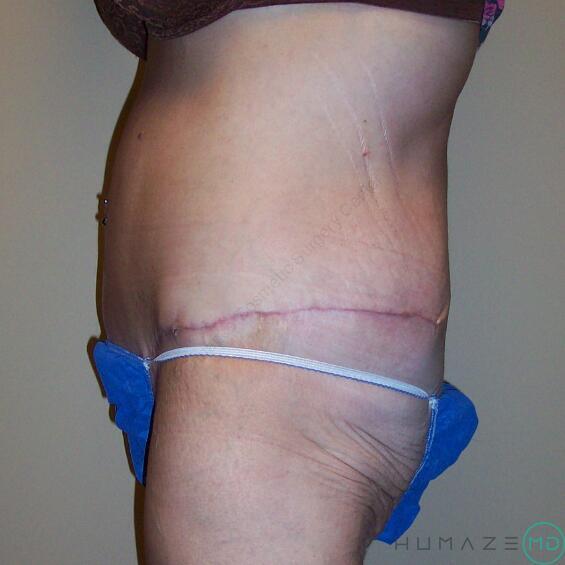 Tummy tuck Before & After Image