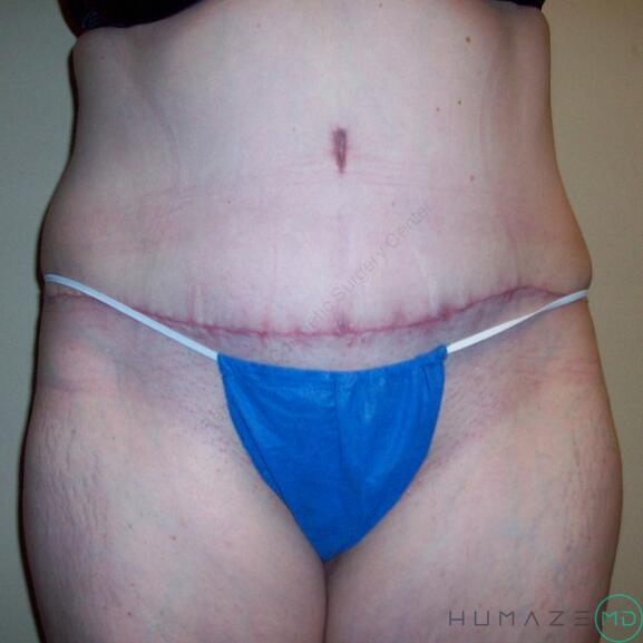 Tummy tuck Before & After Image
