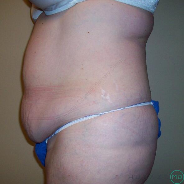 Tummy tuck Before & After Image