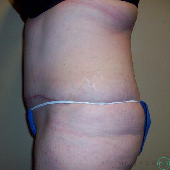 Tummy tuck Before & After Image