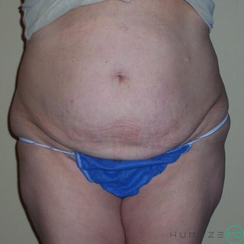 Tummy tuck Before & After Image