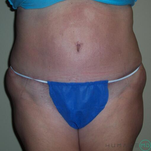 Tummy tuck Before & After Image