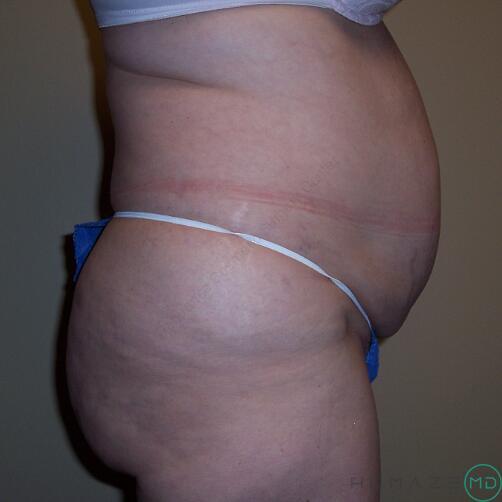 Tummy tuck Before & After Image