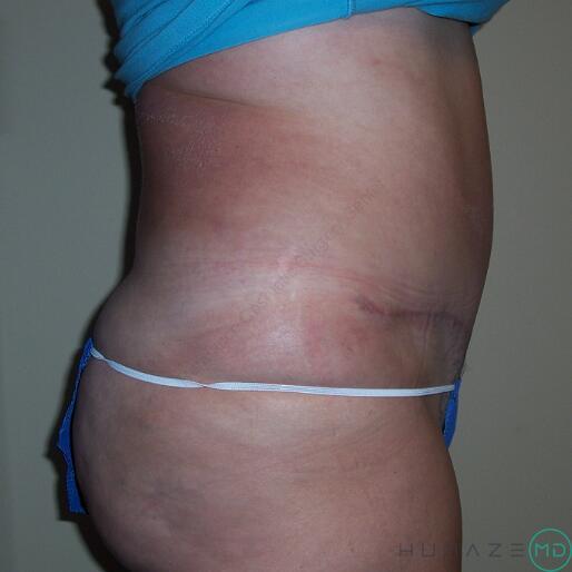 Tummy tuck Before & After Image