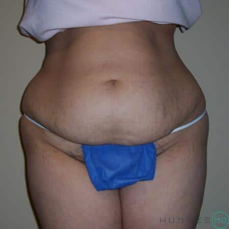 Tummy tuck Before & After Image