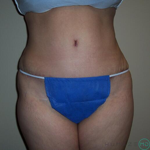 Tummy tuck Before & After Image