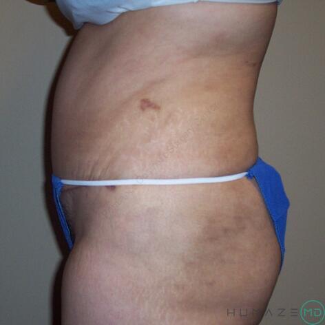 Tummy tuck Before & After Image