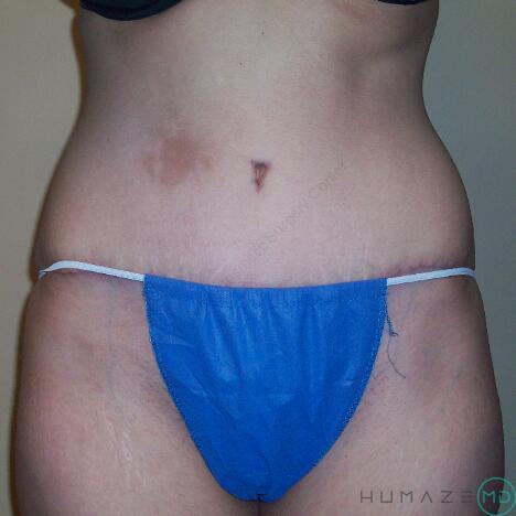 Tummy tuck Before & After Image
