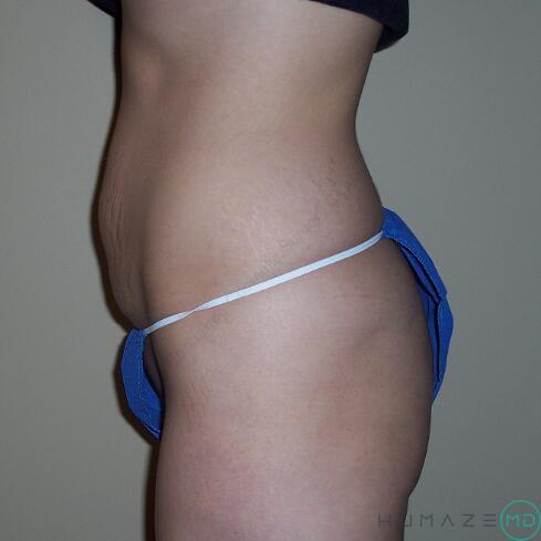 Tummy tuck Before & After Image