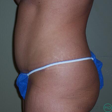 Tummy tuck Before & After Image