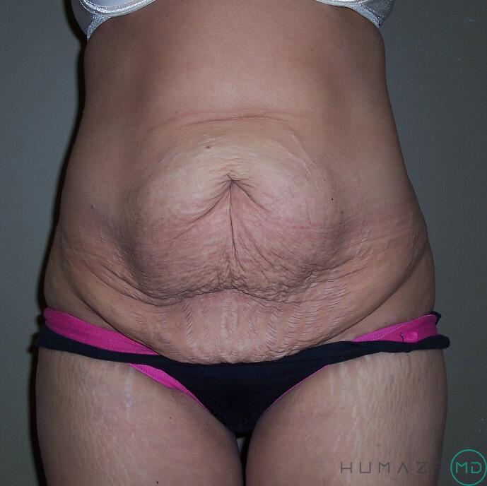 Tummy tuck Before & After Image