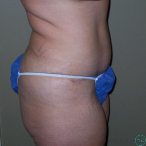 Tummy tuck Before & After Image