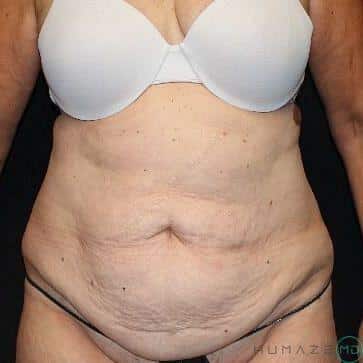 Tummy tuck Before & After Image