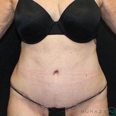 Tummy tuck Before & After Image