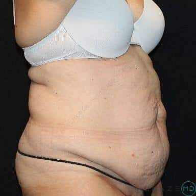 Tummy tuck Before & After Image