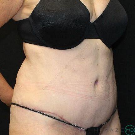 Tummy tuck Before & After Image