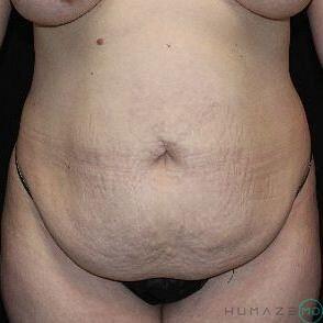 Tummy tuck Before & After Image