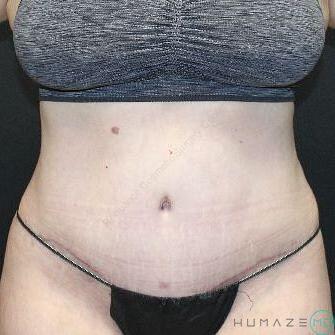 Tummy tuck Before & After Image