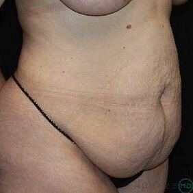 Tummy tuck Before & After Image