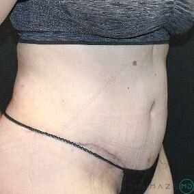 Tummy tuck Before & After Image