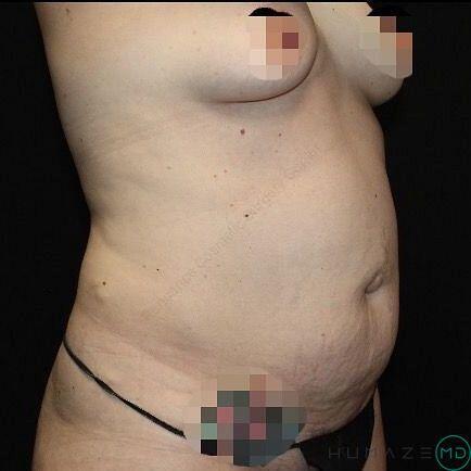 Tummy tuck Before & After Image