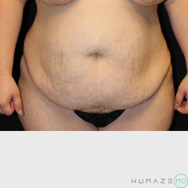 Tummy tuck Before & After Image