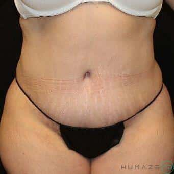 Tummy tuck Before & After Image