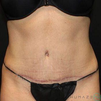 Tummy tuck Before & After Image