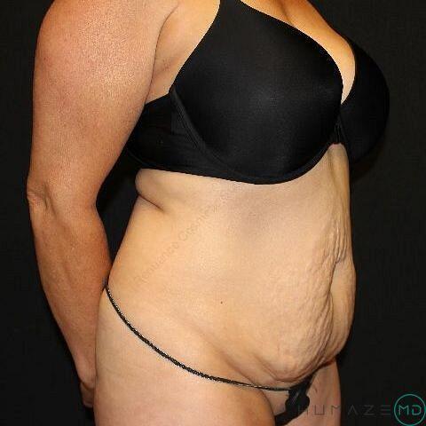 Tummy tuck Before & After Image