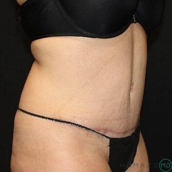 Tummy tuck Before & After Image