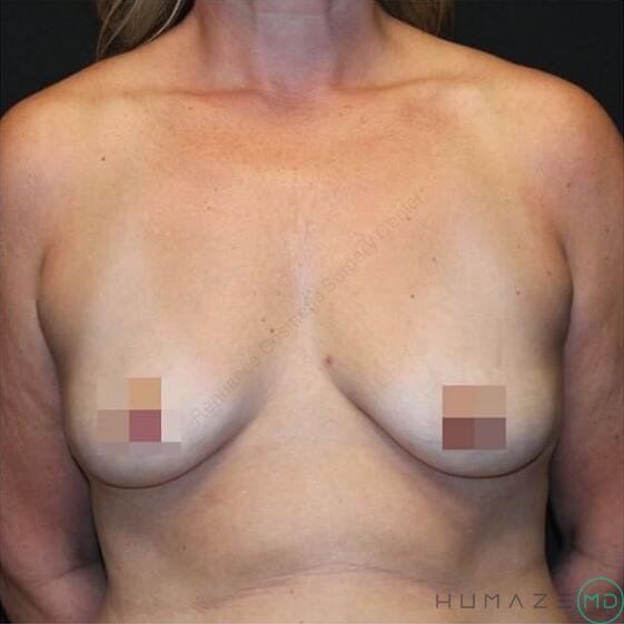 Breast augmentation Before & After Image