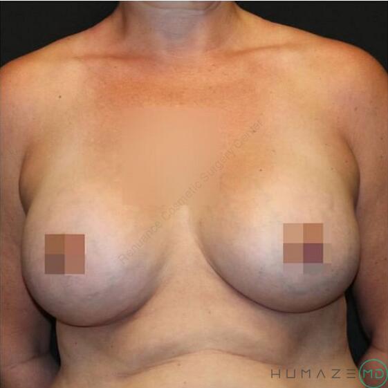 Breast augmentation Before & After Image