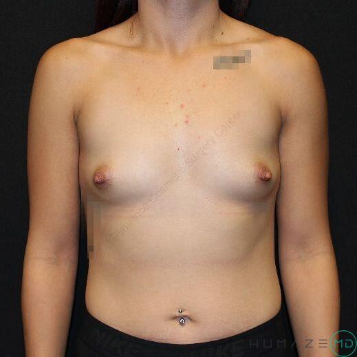 Breast augmentation Before & After Image