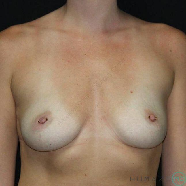Breast augmentation Before & After Image