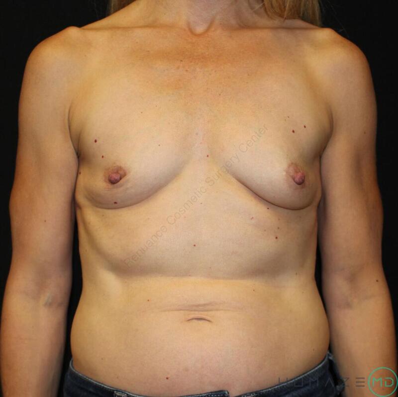 Breast augmentation Before & After Image