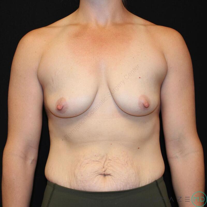 Breast augmentation Before & After Image