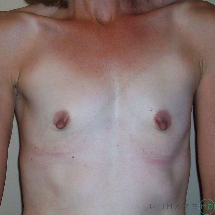 Breast augmentation Before & After Image