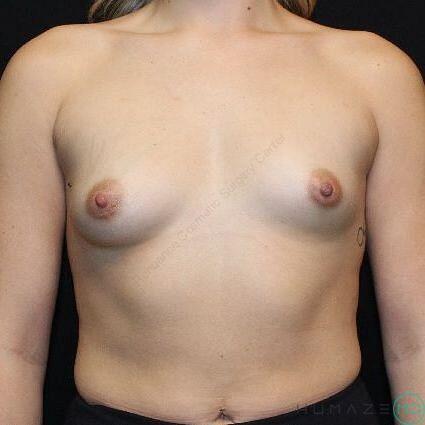 Breast augmentation Before & After Image