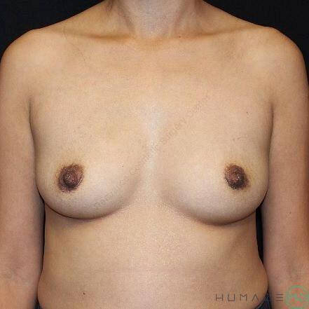 Breast augmentation Before & After Image