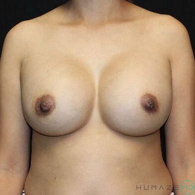 Breast augmentation Before & After Image