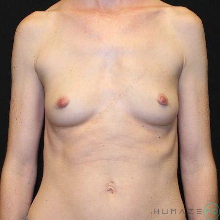 Breast augmentation Before & After Image
