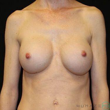 Breast augmentation Before & After Image