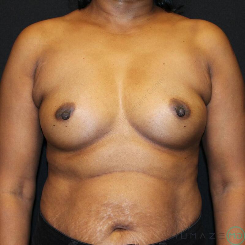 Breast augmentation Before & After Image
