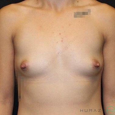 Breast augmentation Before & After Image