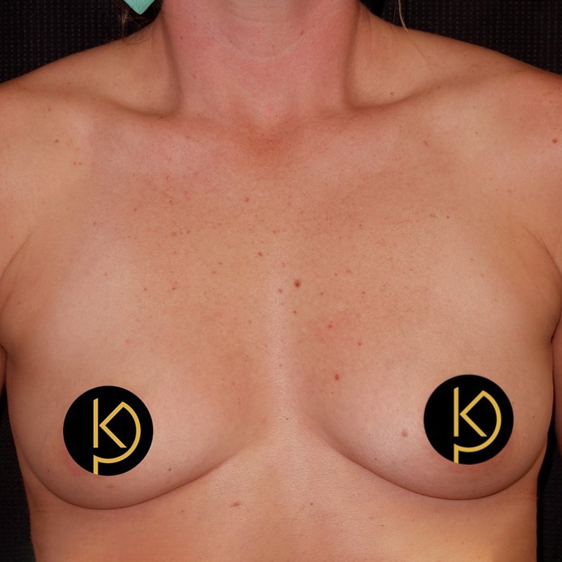 Breast Lift Before & After Image