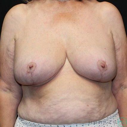 Breast lift Before & After Image