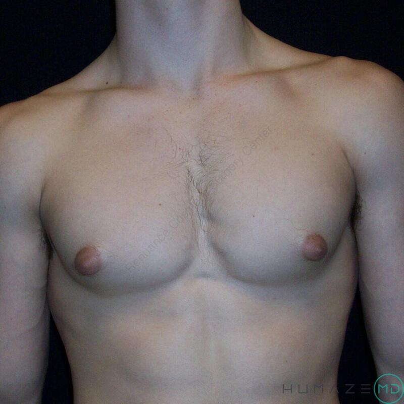 Gynecomastia Surgery Before & After Image